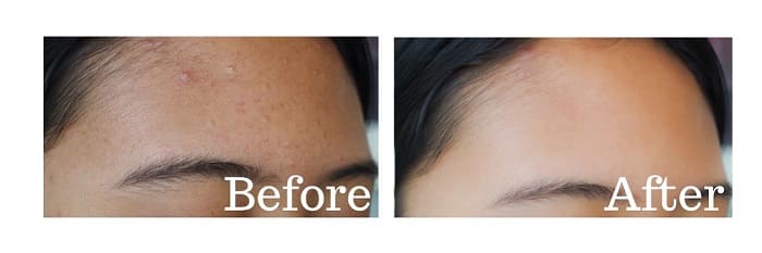 ミレム　ビュートリックの使用前使用後②